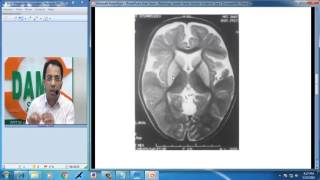 Radiology Spotters Part 27 Glutaric Aciduria Type I Dr Sumer Sethi [upl. by Rehpotsirahc]