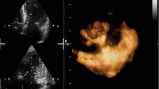 3D MITRAL REGURGITATION PROLAPSE P2 AND P3 [upl. by Alleon103]