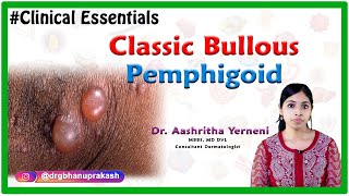 Classic bullous pemphigoid Clinical essentials Dr Aashritha yerneni [upl. by Allak]