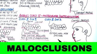 Angles Classification of Malocclusion  Orthodontics [upl. by Rosco]