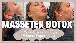 Masseter Botox What It Is and What to Expect [upl. by Anerac]