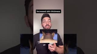 Darker Neck  DermDoctor Explains Acanthosis Nigricans shorts [upl. by Eserehs]