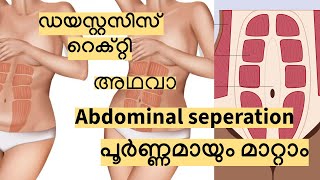 ഡയസ്റ്റസിസ് റെക്റ്റി അഥവാ abdominal separation പൂർണ്ണമായും മാറ്റാം  Exercise for diastasis recti [upl. by Aeneas386]