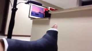 Ankle Fracture Vlog 1  Trimalleolar Fracture [upl. by Artened]