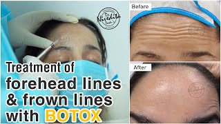 Botox Before And After  Botox Injections  Treatment of Forehead Lines and Frown Lines with Botox [upl. by Stacey]