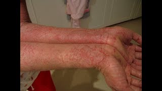 Treatment of eczema and other skin diseases [upl. by Notsirhc769]