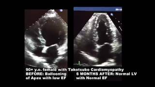 2d Echocardiogram takotsubo Cardiomyopathy [upl. by Aikimat]