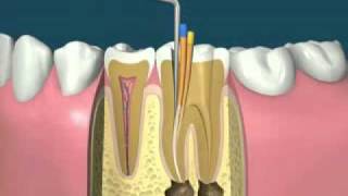 traitement endodontiquedevitalisationflv [upl. by Leryt]