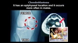 Chondroblastoma  Everything You Need To Know  Dr Nabil Ebraheim [upl. by Im]