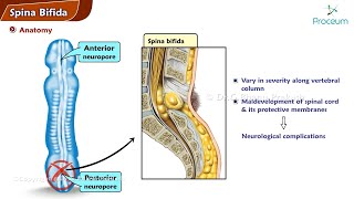 Spina Bifida  Orthopedics Lecture [upl. by Notwen81]