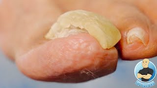 TRIMMING A RAM’S HORN TOENAIL SUPER THICK AND SUPER SATISFYING [upl. by Lavery]