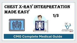 Part 13  Cxray interpretation made easy  chest xray  CMG Complete Medical Guide [upl. by Kai]