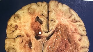 Glioblastoma Awareness Day and Brain Tumor Concept pathology glioblastoma surgery brain [upl. by Ahseyi]