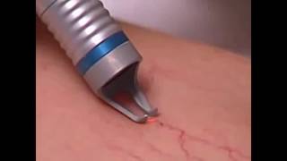 varicose veins removal machine 980nm laser spider vein removal [upl. by Millburn]