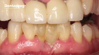 Perio Splint with Immediate Tooth Replacement [upl. by Perlie]