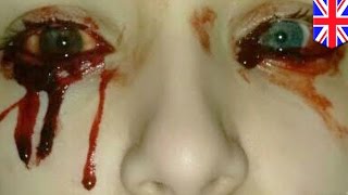 17yearold UK girl cries tears of blood but no one can figure out why [upl. by Tamra921]