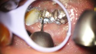 Indepartare ablatie lucrare dentara fara durere Dental crown removal Painless [upl. by Ernestine]