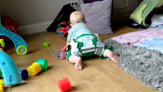 Mobility of baby with a type of Pavlik Harness due to early hip dysplasia [upl. by Nnewg185]