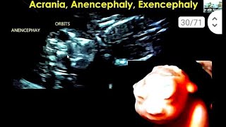 anencephaly 16 सप्ताह के बच्चे का हेडब्रेन brain 🧠 का नही बनना [upl. by Leiand483]