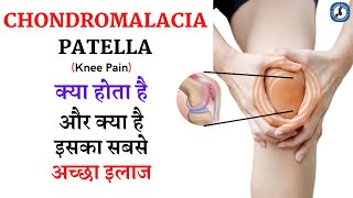 Chondromalacia patella क्या होता है  और क्या है इसका सबसे अच्छा इलाज [upl. by Felicio]