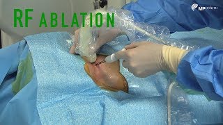 Radiofrequency Ablation [upl. by Tterb]