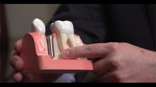 Same Day Dental Implant Procedure with Oral Surgeon Dr John Wallace [upl. by Seuguh]