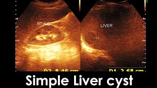 Simple Liver cyst  Enlarge prostate  Practical case [upl. by Asserrac]