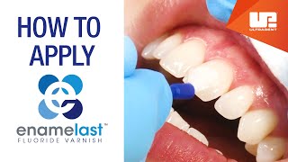 How to Apply Enamelast Fluoride Varnish  StepbyStep [upl. by Capon]