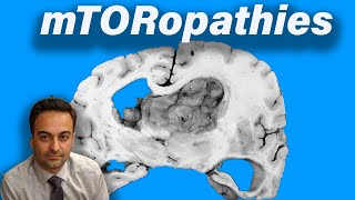 Tuberous Sclerosis Complex and other mTORopathies [upl. by Asinla]