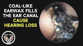 COALLIKE CERUMEN FILLS The Ear Canal Causes Hearing Loss [upl. by Brynne28]