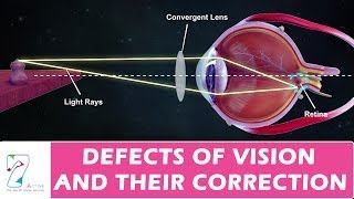 DEFECTS OF VISION AND THEIR CORRECTION [upl. by Aniz]