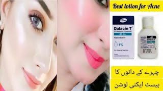 100 Remove Acne amp pimple Guaranteed results self tested Dalacin T lotion honest review [upl. by Annotahs82]