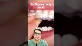 Do Aligners Really work youtubeshorts shortvideo shorts short teeth braces aligners [upl. by Elyagiba]