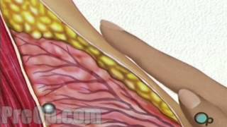 Breast Biopsy Incisional Surgery  PreOp Patient Education Medical HD [upl. by Amyas]