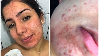 TRATAMENTO DE ACNE Meciclinepiduogel e episol [upl. by Gomar]