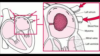 Left atrial myxoma [upl. by Tierza]