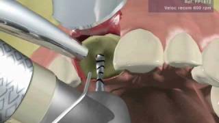 IMPLANTE DENTAL UNITARIO fase quirúrgica [upl. by Sallad]