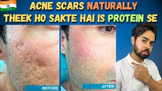 Remove Acne Scars Naturally  3 Remedies 100 Works With Results [upl. by Anemij]