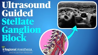 Ultrasound guided stellate ganglion block [upl. by Ellerahs]