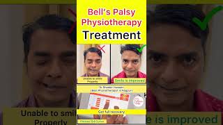 Bell’s palsy Physiotherapy Treatment Results bellspalsy physiotherapy shorts [upl. by Anidal777]