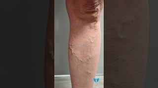 What to Expect During and After a VenaSeal™ Procedure for Varicose Vein Treatment [upl. by Aivila]