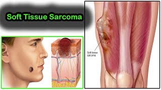 Soft Tissue Sarcoma What is Soft Tissue Sarcoma Symptoms And Treatment  Kaposi Sarcoma [upl. by Idahs]