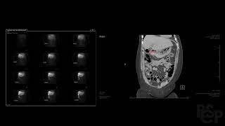 Hebatobiliary Scintigraphy Explained HIDA scan [upl. by Telocin]