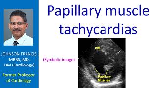 Papillary muscle tachycardias [upl. by Ayokal]