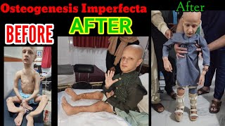 Osteogenesis Imperfecta CASE 1Video 6 Started Standing amp Taking Steps after 18 years of waiting [upl. by Reivaz594]