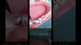 CLASS 2 MOD MANDIBULAR MOLAR CAVITY PREPARATIOM 🦷🦷 dentaltips dentistry dentalstudenteducation [upl. by Schoof]