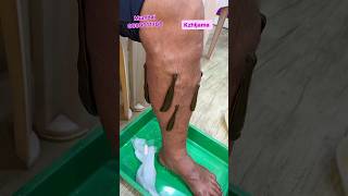 Can leeches treat varicose veins  LEECH THERAPY kzhijamaleechleechtherapyvaricoseveinsshorts [upl. by Tada477]