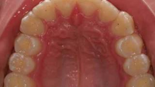 invisalign severe overjet [upl. by Leifer]