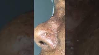 Satisfying Pimple Popping  Blackheads And Acne  Best Pimple Popping Compilation Videos Shorts [upl. by Baird116]