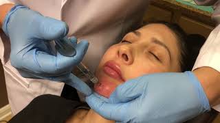 NonSurgical Chin Augmentation using Juvederm Voluma 3cc [upl. by Telfore903]